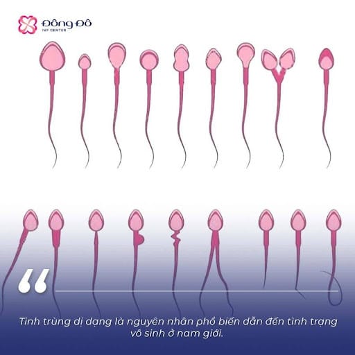Phương pháp ICSI đem lại hy vọng cho những trường hợp tinh trùng dị dạng 100% như anh Đông.