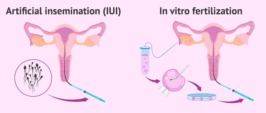 IUI và IVF