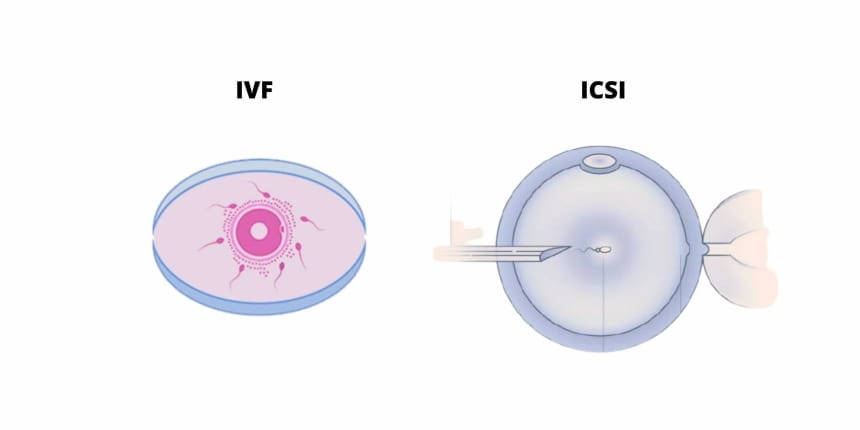 IVF ICSI và IVF truyền thống