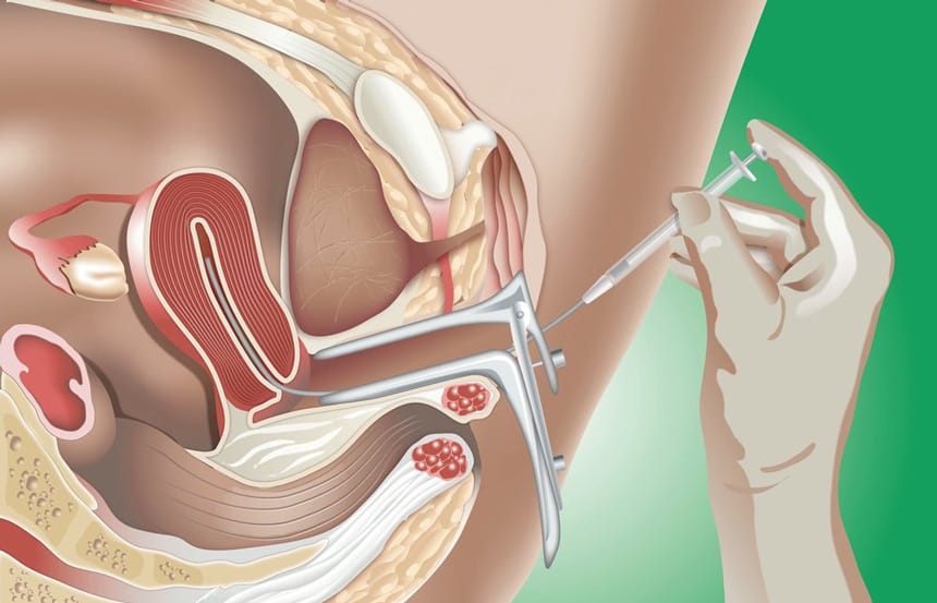 Tìm hiểu cơ chế hoạt động của IUI và quá trình thụ thai