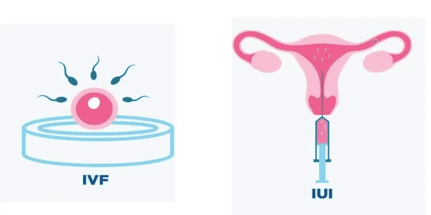 Chị em muốn làm mẹ đơn thân có thể lựa chọn IUI hoặc IVF