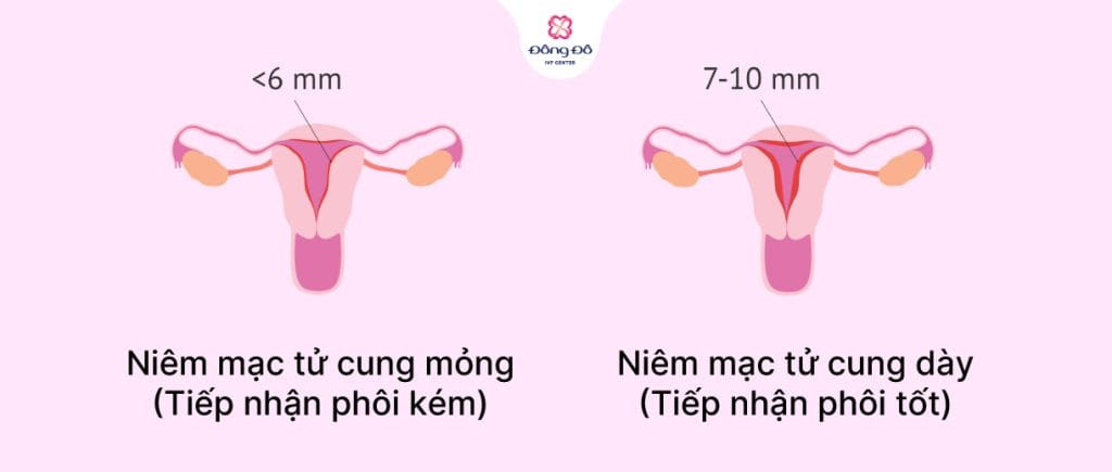 Độ dày (Độ dày nội mạc tử cung - EMT)