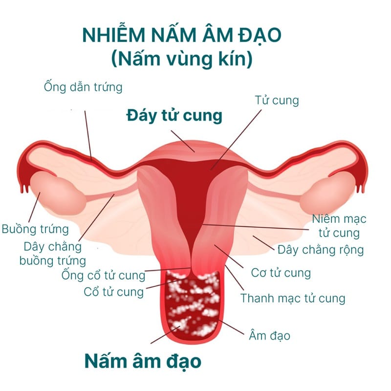 Phòng ngừa nấm vùng kín hiệu quả