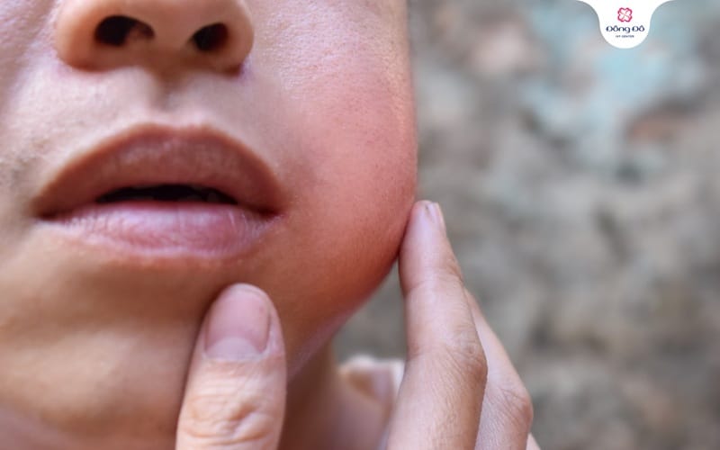 Người lớn có bị quai bị không?