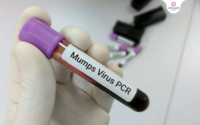 Chẩn đoán bệnh quai bị qua xét nghiệm PCR