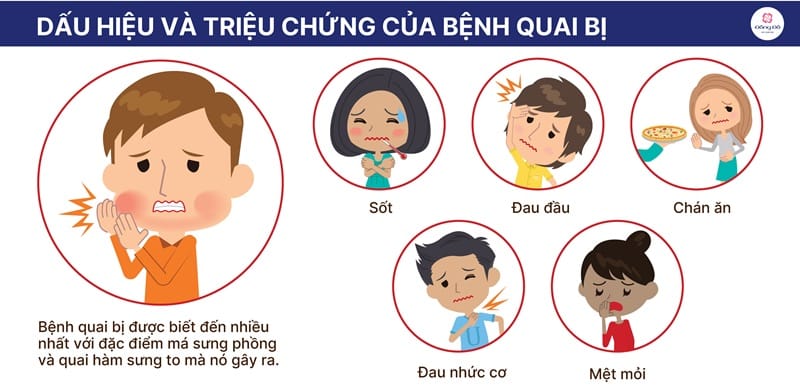 Triệu chứng quai bị điển hình