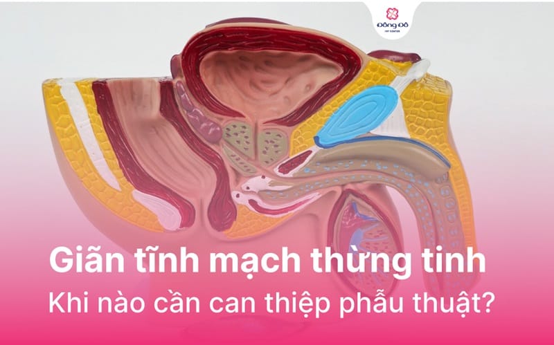 Giãn tĩnh mạch thừng tinh là gì?