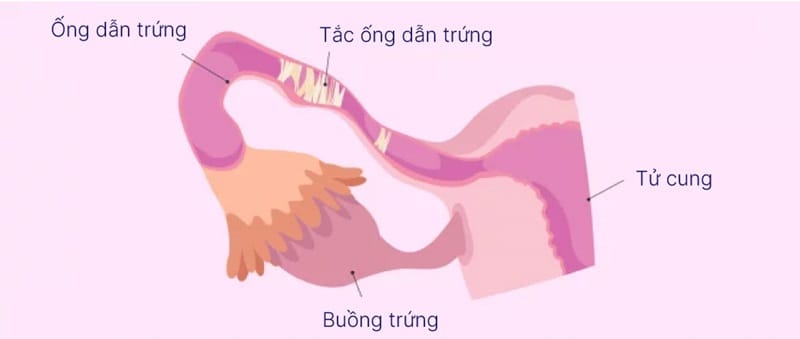 Các vấn đề về ống dẫn trứng