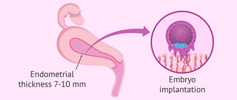 Niêm mạc tử cung mỏng