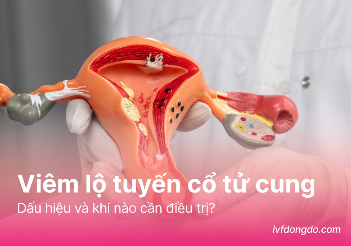 Viêm lộ tuyến cổ tử cung là gì? Dấu hiệu và khi nào cần điều trị?