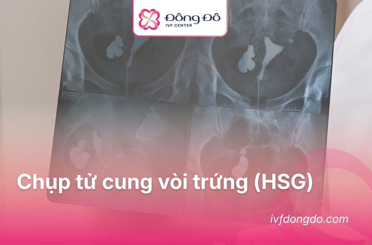 làm ivf có cần chụp tử cung vòi trứng không
