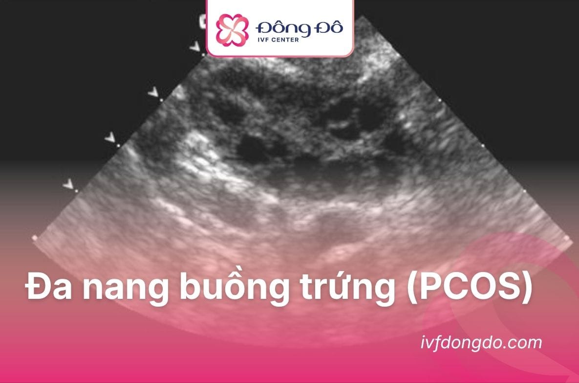 đa nang buồng trứng