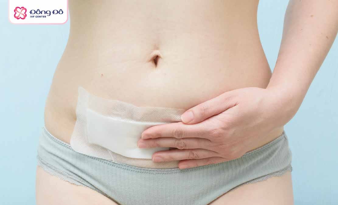 Dính buồng tử cung thường là biến chứng sau sinh mổ