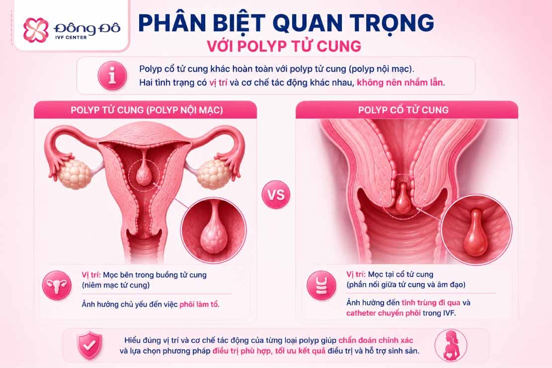 Inforgraphic phân biệt polyp cổ tử cung và polyp lòng tử cung