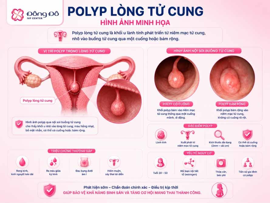 Inforgraphic về Polyp lòng tử cung - endometrial polyp