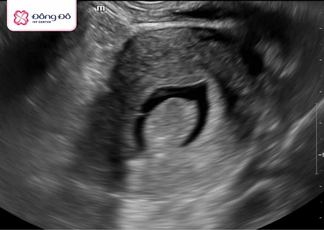 Hình ảnh siêu âm polyp tử cung
