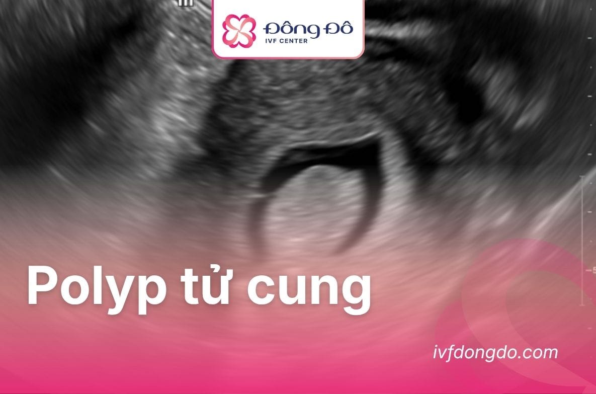 Polyp tử cung