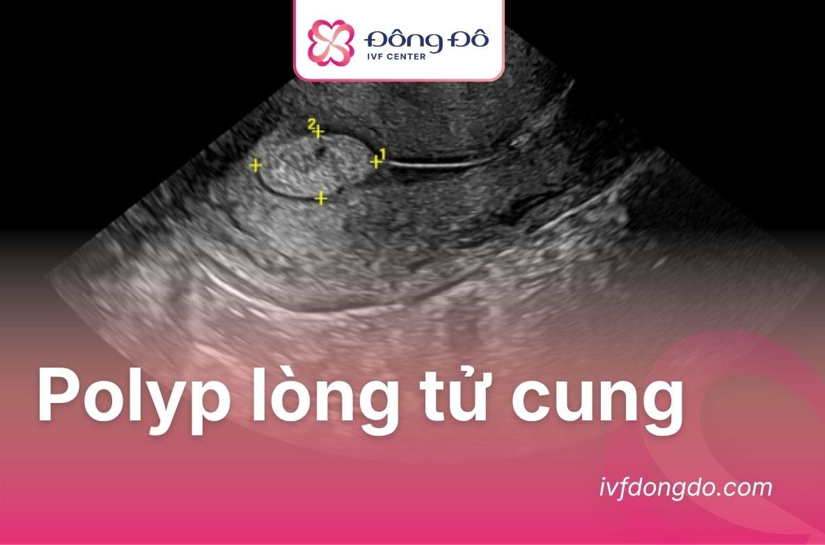 Polyp lòng tử cung