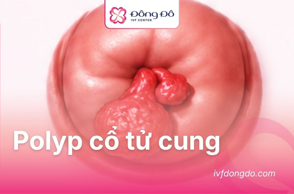 Polyp cổ tử cung