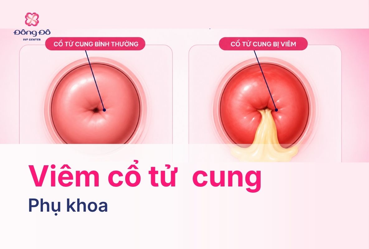 Viêm Cổ Tử Cung: Dấu Hiệu, Nguyên Nhân Và Ảnh Hưởng Sinh Sản