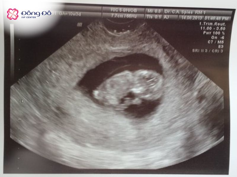 Hình ảnh siêu âm thai IVF tuần 5-10