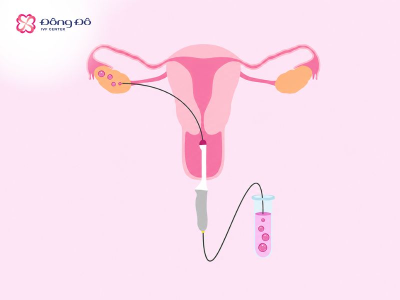 Minh họa quá trình chọc hút noãn