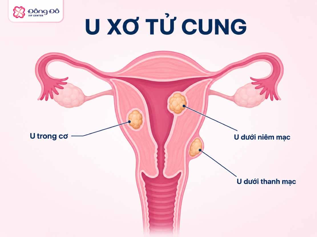 Phân loại u xơ tử cung - loại nào ảnh hưởng đến khả năng mang thai?