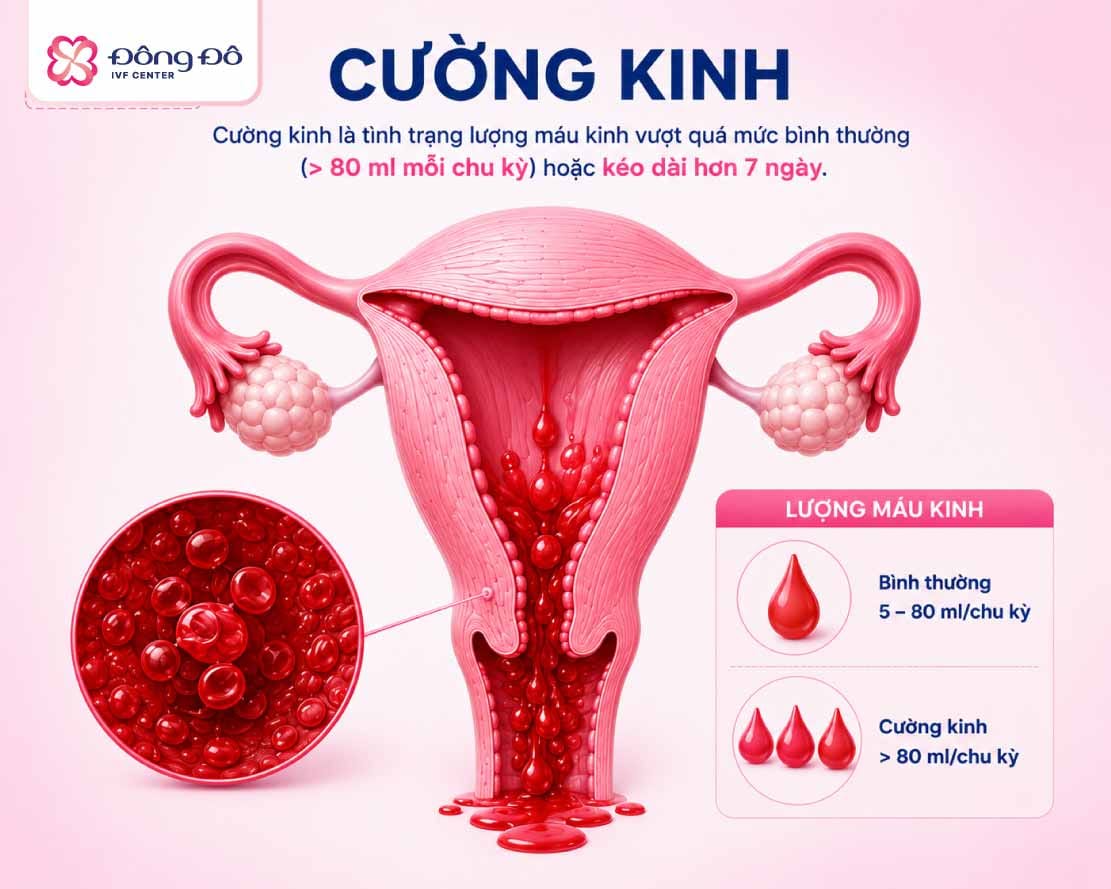Cường kinh cũng là 1 dấu hiệu quan trọng của u xơ tử cung