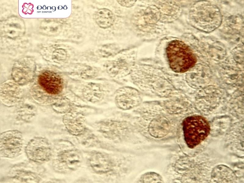 Xét nghiệm Chlamydia để tìm tác nhân gây bệnh viêm cổ tử cung