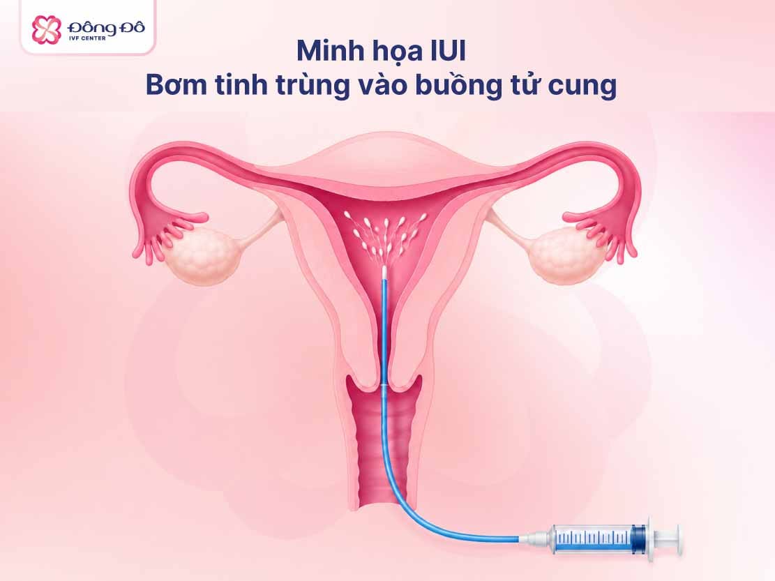 Điều trị viêm vùng chậu thường được ưu tiên để tăng tỷ lệ thành công IUI