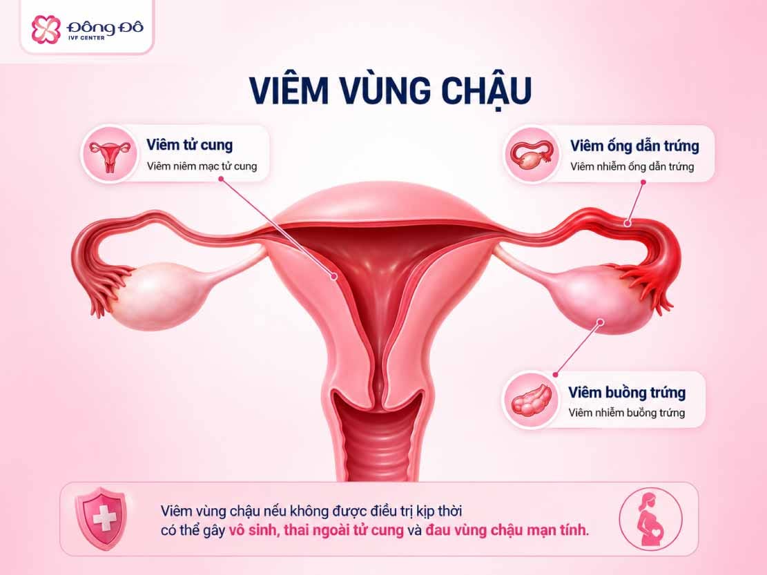 Viêm vùng chậu xảy ra khi các cơ quan sinh sản của phụ nữ bị nhiễm trùng, viêm nhiễm