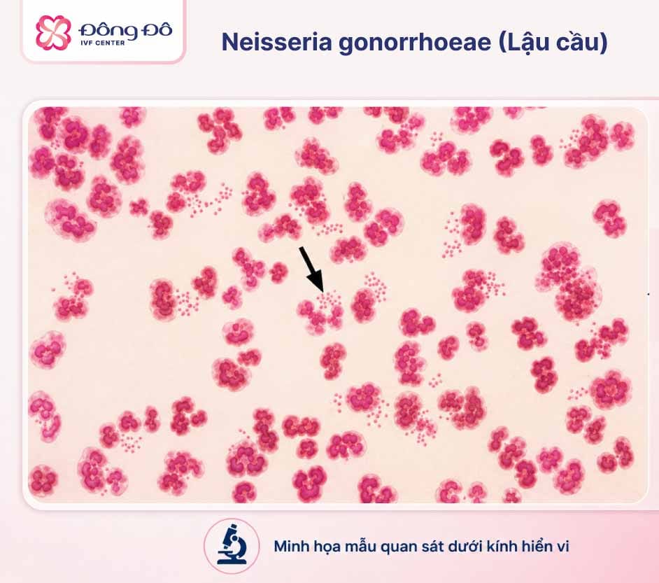 Nguyên nhân và yếu tố nguy cơ viêm vùng chậu