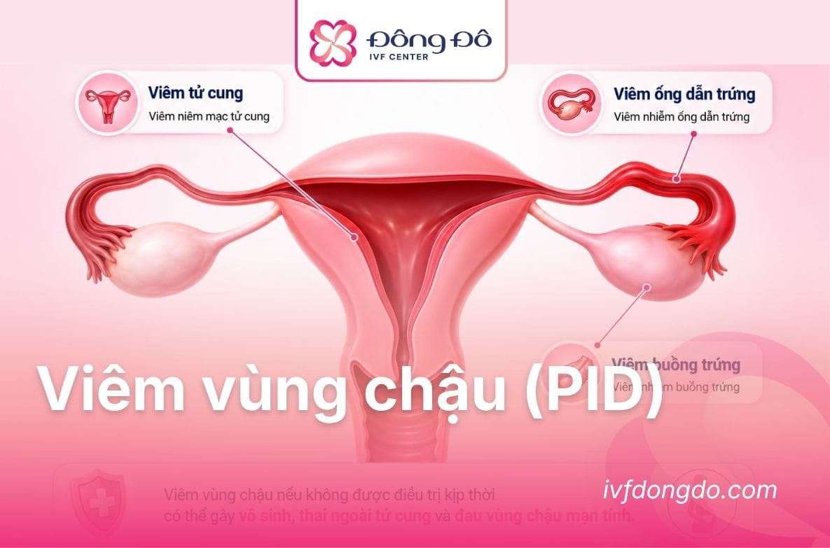 viêm vùng chậu