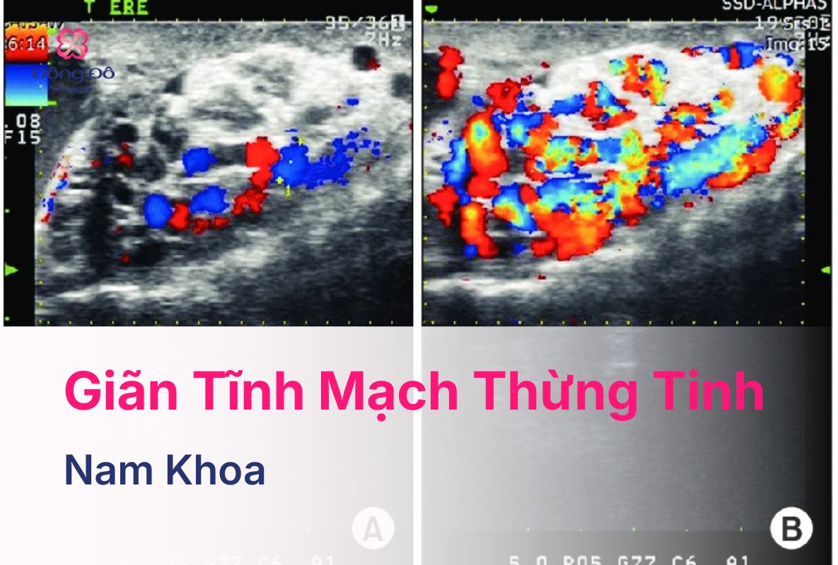 Giãn Tĩnh Mạch Thừng Tinh Nguyên Nhân Và Ảnh Hưởng Tới Sinh Sản (26)