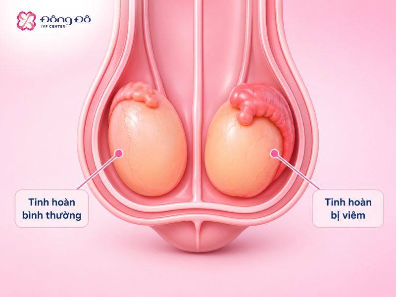 Hình ảnh minh họa tình trạng viêm tinh hoàn
