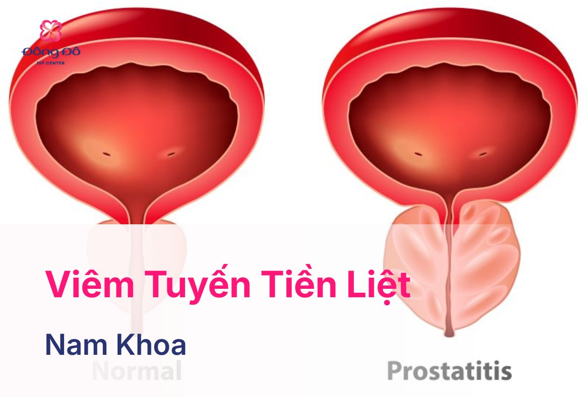 Viêm Tuyến Tiền Liệt: Dấu Hiệu, Nguyên Nhân, Cách Điều Trị