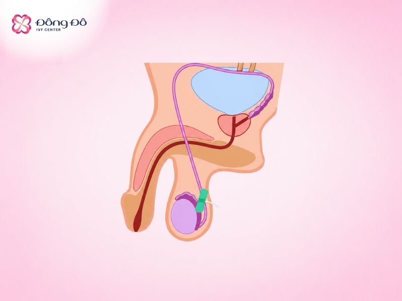 Trích tinh trùng từ mào tinh, sau đó thực hiện thụ tinh trong ống nghiệm có thể giúp gia đình sinh con mà không cần thông tắc ống dẫn tinh