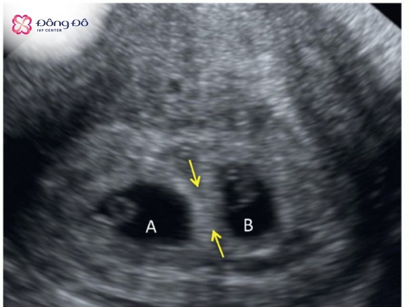 Làm IVF thường có nguy cơ đa thai cao hơn do thường cần chuyển nhiều phôi (1-2 phôi tùy vào thể trạng của mẹ) để tăng tỷ lệ thành công