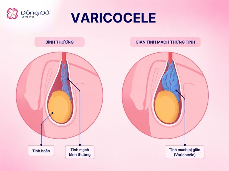 Giãn tĩnh mạch thừng tinh là một nguyên nhân quan trọng dẫn đến tinh trùng yếu