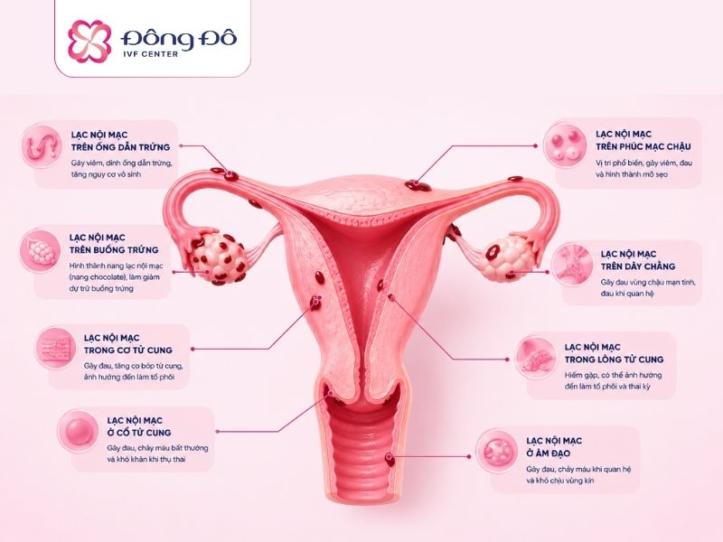 Phụ nữ mắc lạc nội mạc tử cung có thể gây nguy hiểm tới buồng trứng, nên trữ trứng khi có chỉ định của bác sĩ