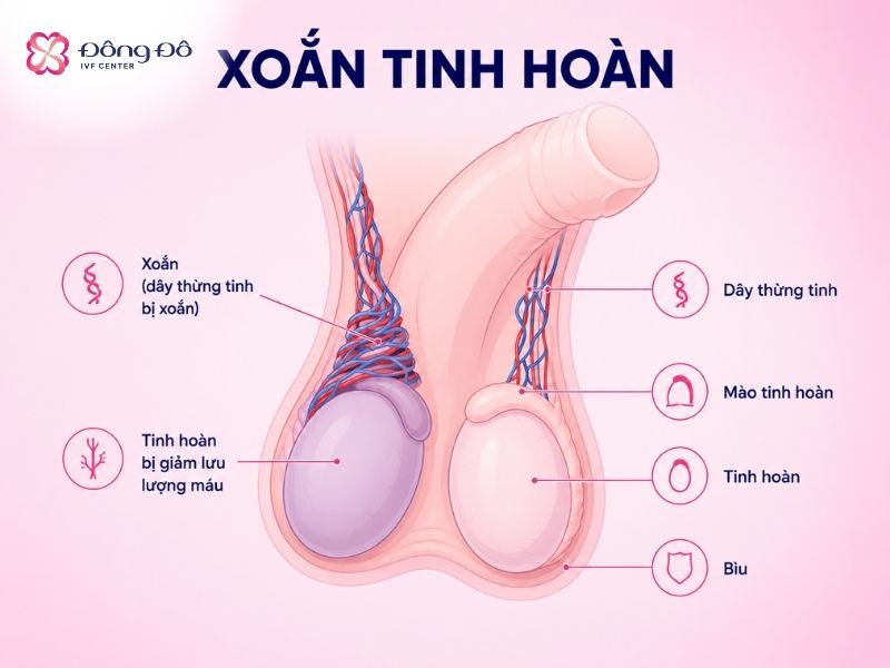 Xoắn tinh hoàn gây ra cơn đau dữ dội, khác hẳn với viêm mào tinh hoàn