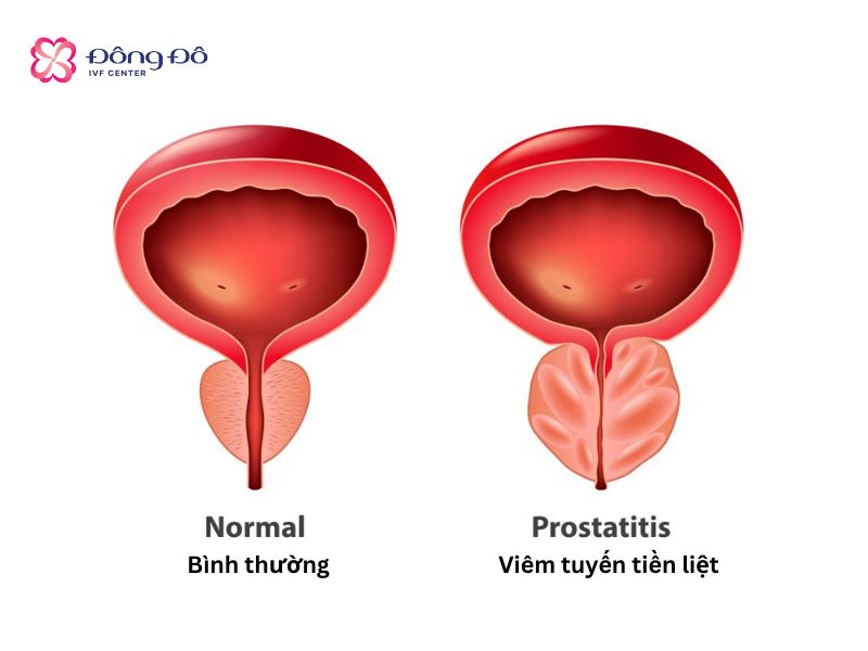 Rối loạn tiểu tiện là một trong những dấu hiệu phổ biến nhất của viêm tuyến tiền liệt