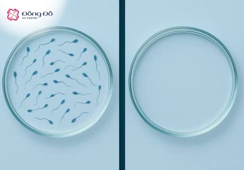 Mất đoạn AZFa dẫn tới vô tinh ở nam giới